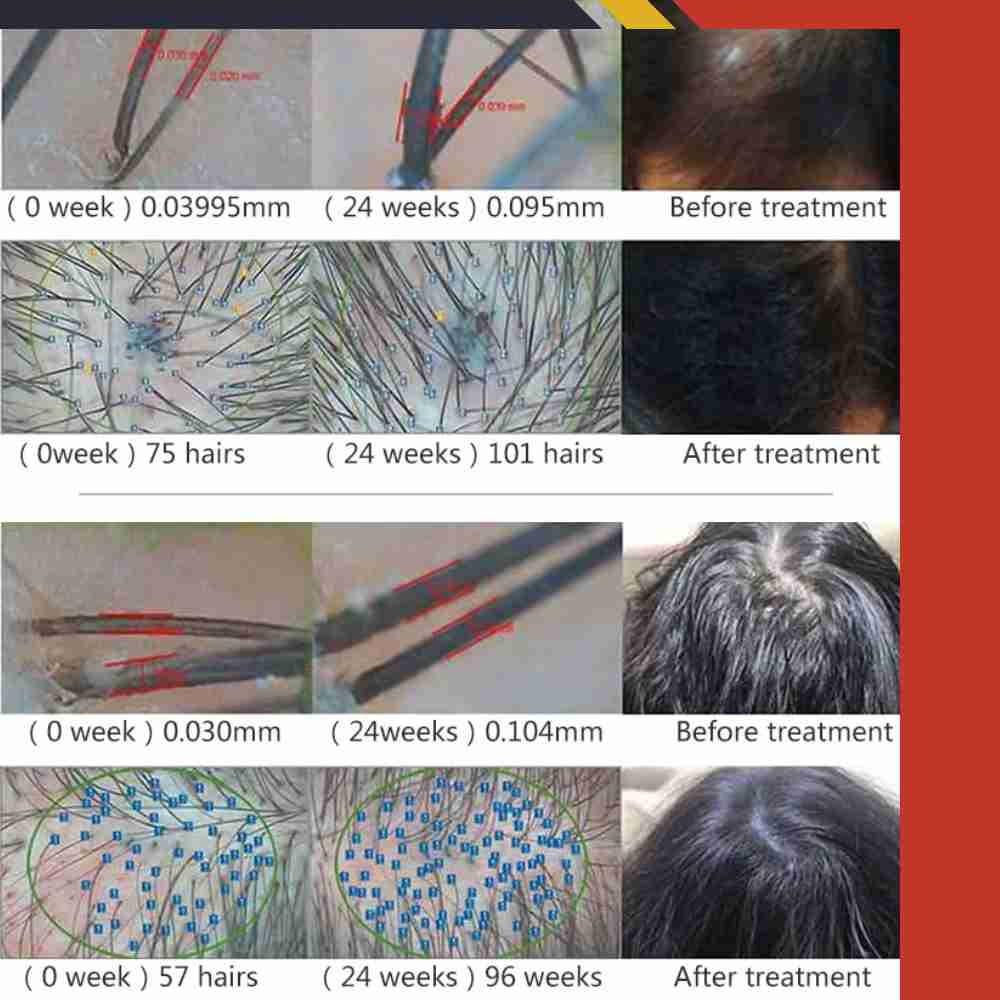 Valenluma Latest Technology Laser Hair Growth Helmet for Hair Loss Treatment